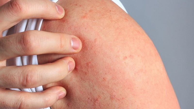 Nổi mề đay có tự hết không và cách chăm sóc tại nhà cho bà con