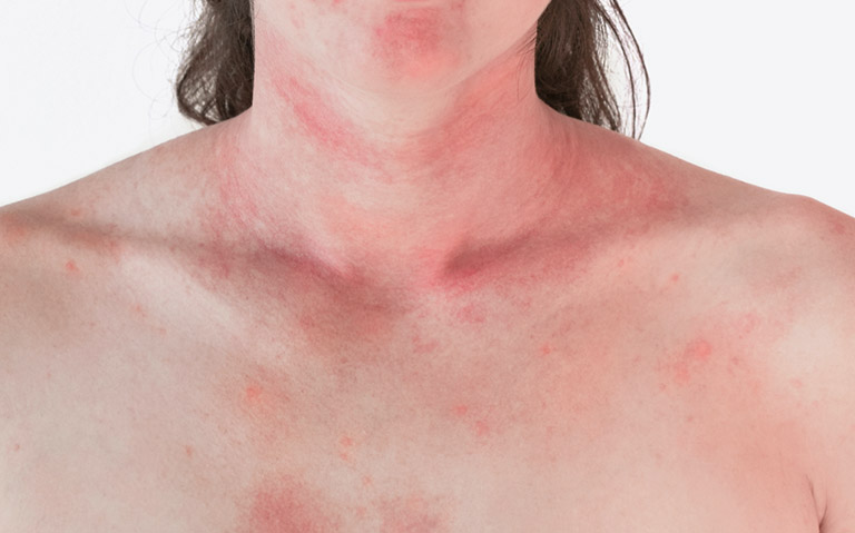 Nổi Mề Đay Ngứa Toàn Thân Là Bệnh Gì? Cách Nhận Biết Và Điều Trị Từ Y Học Cổ Truyền