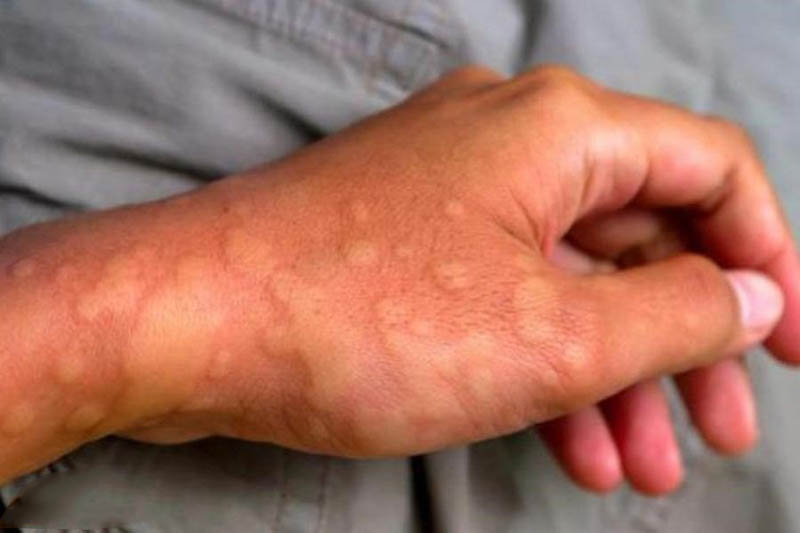 Nổi mề đay vào sáng sớm: Dấu hiệu bà con chớ nên xem nhẹ