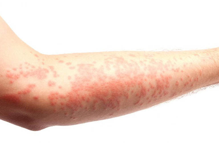 Nổi mẩn ngứa ở tay: Triệu chứng chớ nên xem thường