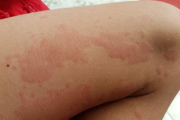 Nóng trong người nổi mề đay: Đừng coi thường dấu hiệu tưởng chừng nhỏ bé