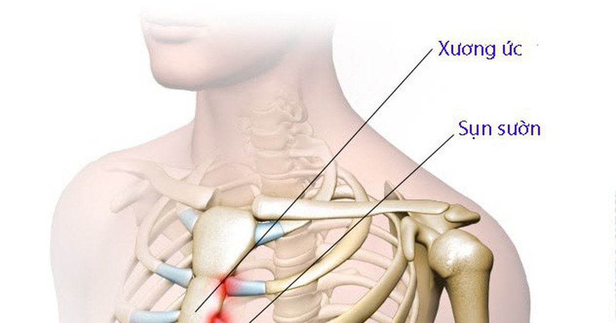 Viêm khớp ức sườn: Chớ để dấu hiệu nhỏ thành nỗi đau lớn