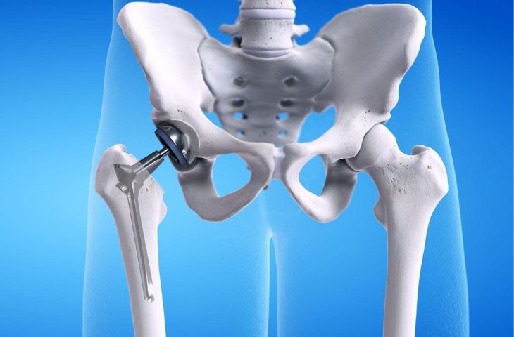 Thay khớp háng bao lâu đi xe máy được? – Lão Tuấn dặn dò