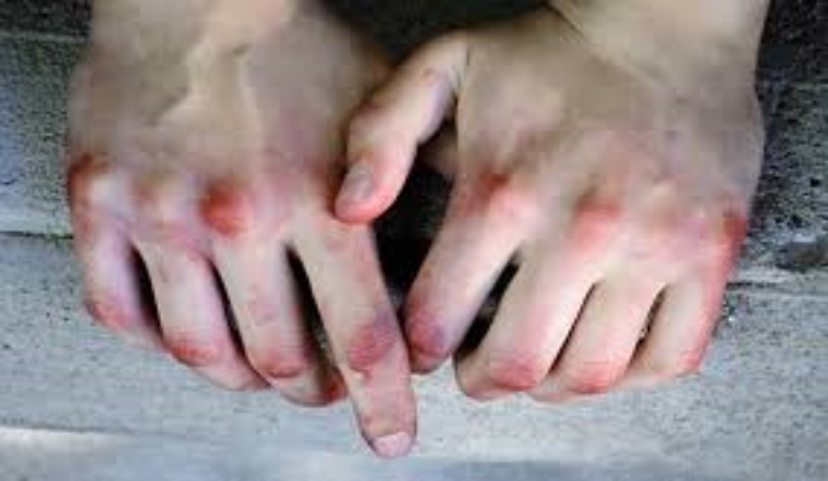 Khớp ngón tay bị thâm đen – Dấu hiệu chớ coi thường