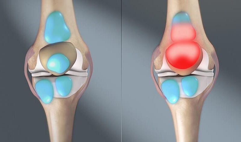 Tràn dịch khớp gối có chữa khỏi được không? Cách phục hồi