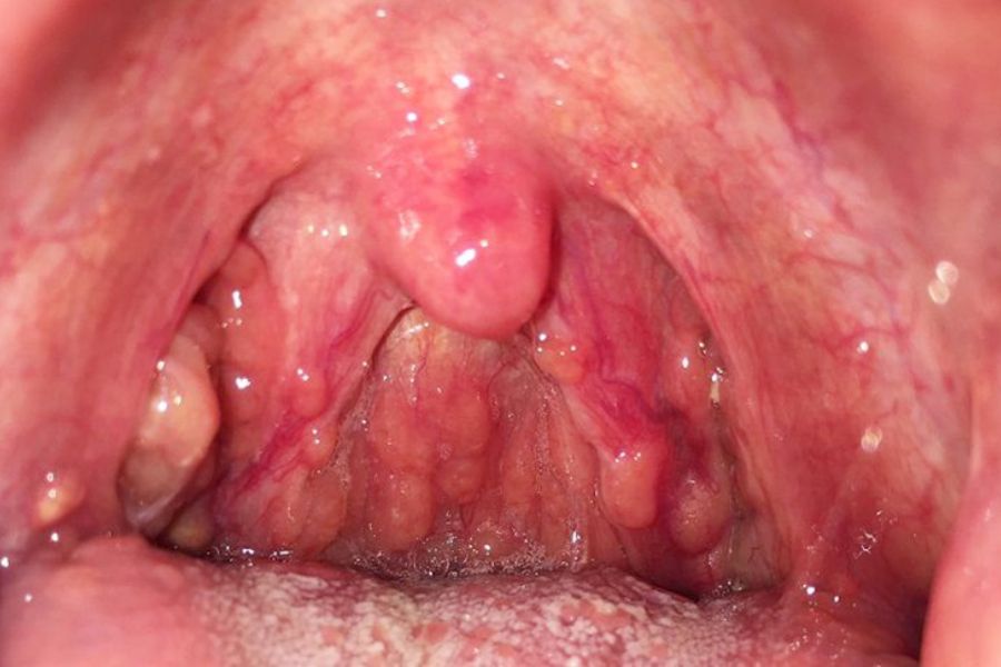 Trào ngược dạ dày gây viêm họng – Chớ coi thường dấu hiệu nhỏ