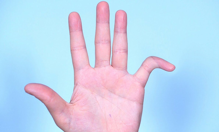 Bị trật khớp tay phải làm sao? Cách xử lý theo Đông y