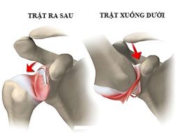 Trật khớp vai ra sau: Đừng coi thường dấu hiệu ngỡ là nhẹ