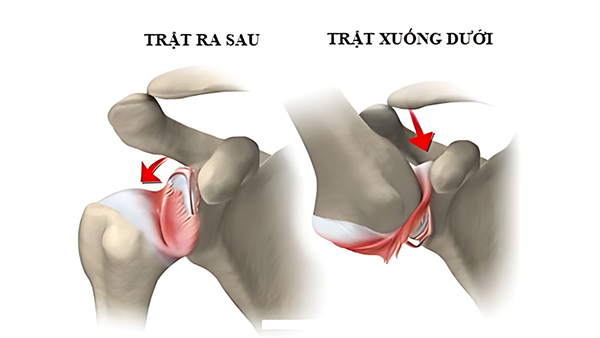 Trật khớp vai: Đừng chủ quan với chấn thương tưởng nhỏ