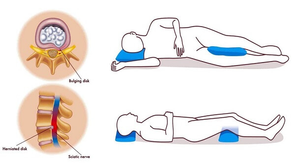 Tư thế ngủ cho người thoát vị đĩa đệm: đừng xem thường!