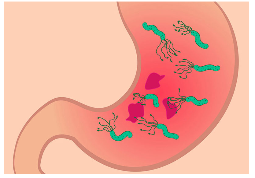 Cảnh báo viêm teo niêm mạc dạ dày âm thầm mà nguy hiểm