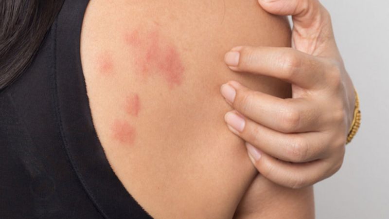 Nổi mẩn đỏ ngứa khi ra mồ hôi: Chớ coi thường dấu hiệu nhỏ mà bỏ qua căn nguyên bên trong