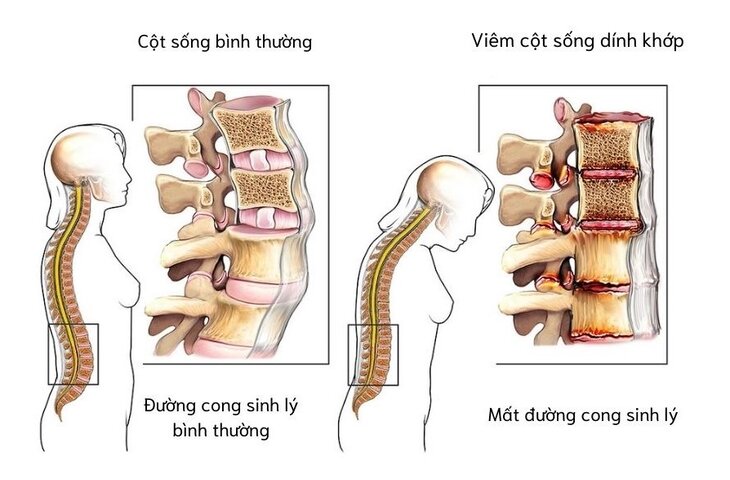 Viêm cột sống dính khớp là gì? Hiểu đúng để sống khỏe