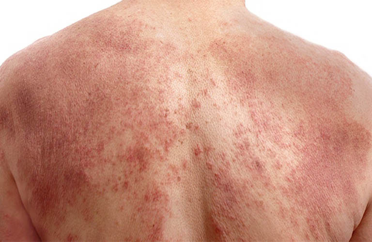 Nổi Mẩn Ngứa Để Lại Vết Thâm: Nguyên Nhân và Cách Điều Trị Theo Y Học Cổ Truyền
