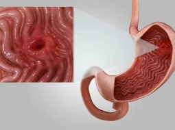 Viêm dạ dày cấp: Chớ để "lửa nhỏ" âm ỉ thành họa lớn