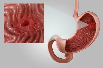 Viêm dạ dày cấp: Chớ để "lửa nhỏ" âm ỉ thành họa lớn