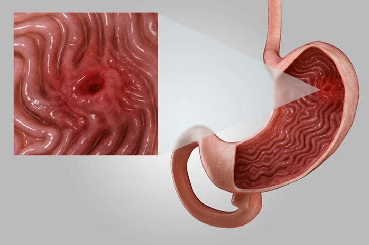 Viêm dạ dày cấp: Chớ để "lửa nhỏ" âm ỉ thành họa lớn