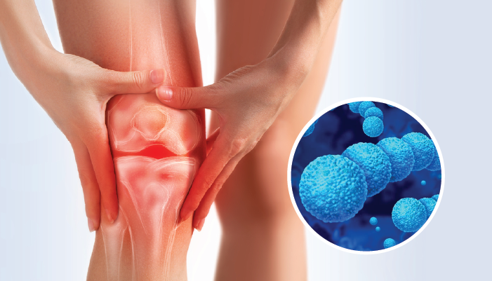 Viêm khớp liên cầu: Đừng coi thường khi khớp sưng nóng, đỏ đau