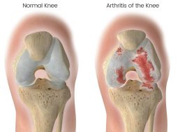 Viêm khớp gối – đừng để âm ỉ hóa thành tàn phế