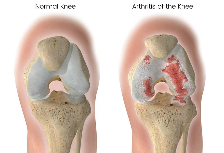 Viêm khớp gối – đừng để âm ỉ hóa thành tàn phế