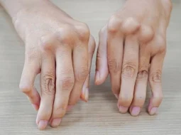 Viêm khớp tự miễn: Đừng để âm ỷ hóa thành tàn phế