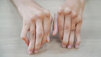 Viêm khớp tự miễn: Đừng để âm ỷ hóa thành tàn phế