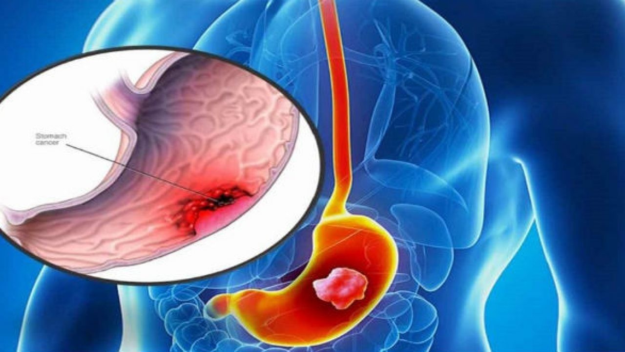 Viêm niêm mạc dạ dày: Dấu hiệu âm thầm không nên xem nhẹ