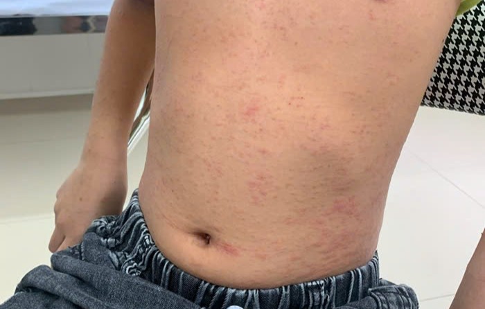 Nổi mề đay có liên quan đến gan không? Góc nhìn chuyên môn từ Lão Tuấn