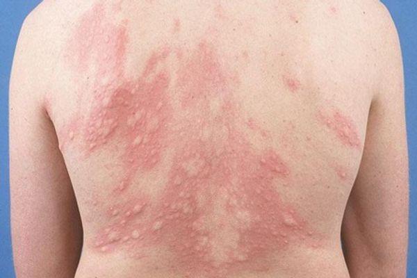 Da nổi mẩn đỏ từng mảng không ngứa: Lão Tuấn chia sẻ cách nhận biết và chăm sóc