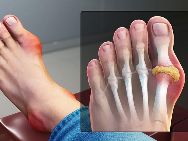 Bệnh gout có trị dứt điểm được không và lời nhắn nhủ từ Lão Tuấn