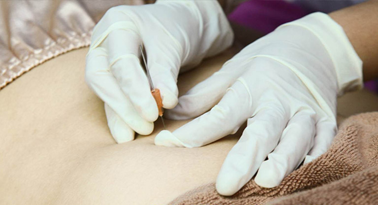 Cấy chỉ thoát vị đĩa đệm có hiệu quả không? Lời nhắn nhủ từ Lão Tuấn