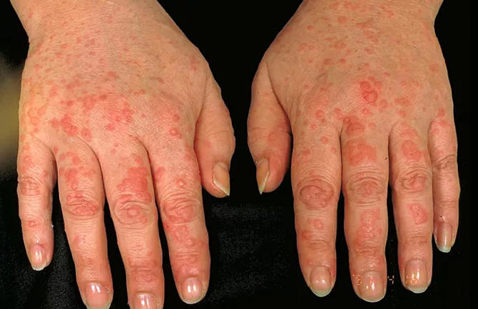 Viêm khớp vảy nến: Nỗi lo tàn phế và cách nhìn thấu căn nguyên từ Đông y