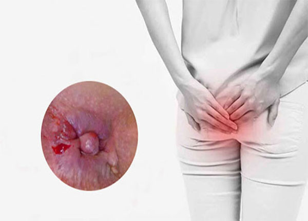 Dấu hiệu bệnh trĩ và lời dặn từ Lão Tuấn để sống khỏe tại nhà