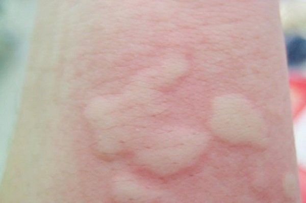 Nổi mẩn ngứa sưng to: Nhận biết, chăm sóc và hướng điều trị theo Y học cổ truyền