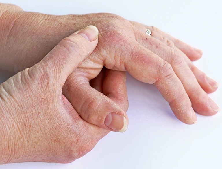 Viêm khớp vảy nến ở bàn chân: Đừng để đôi trụ cột cơ thể mục rỗng vì tà khí