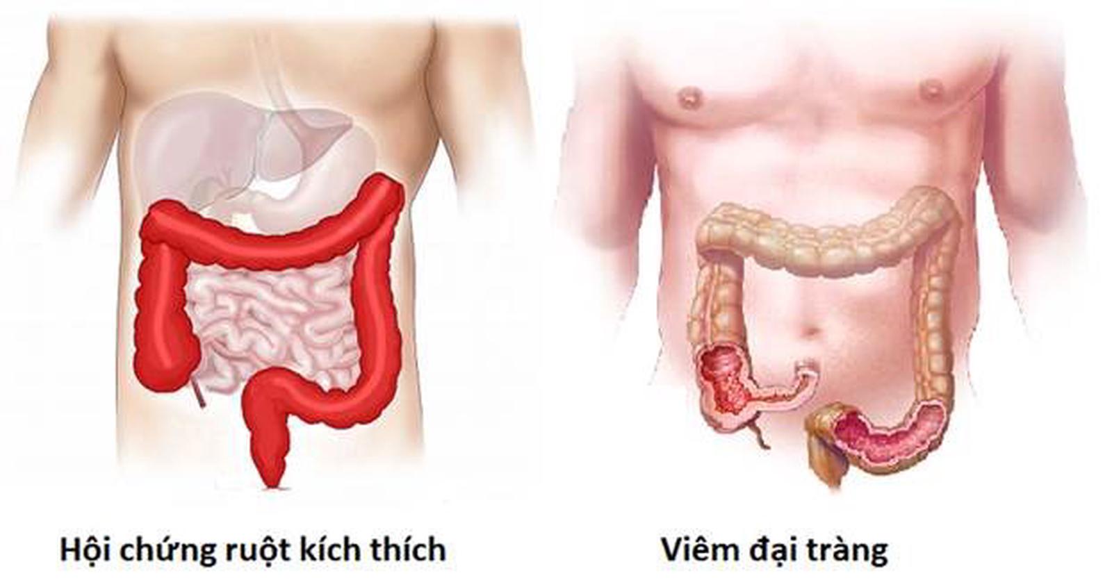 Phân biệt hội chứng ruột kích thích và viêm đại tràng để trị đúng gốc