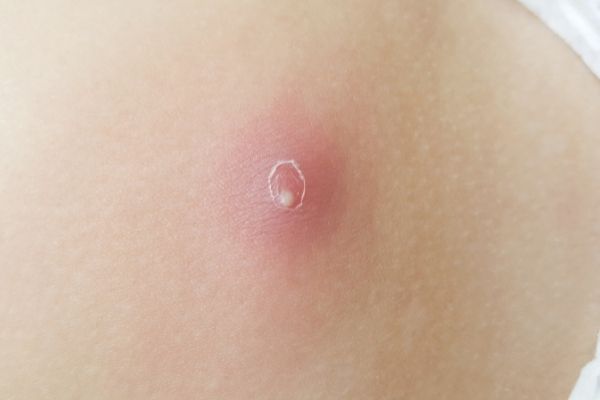 5 loại vi khuẩn thường gặp gây áp xe ổ bụng bà con cần cảnh giác