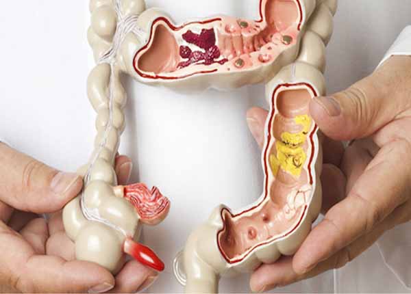 Bệnh trĩ và viêm loét đại tràng: Cách phân biệt và điều trị dứt điểm