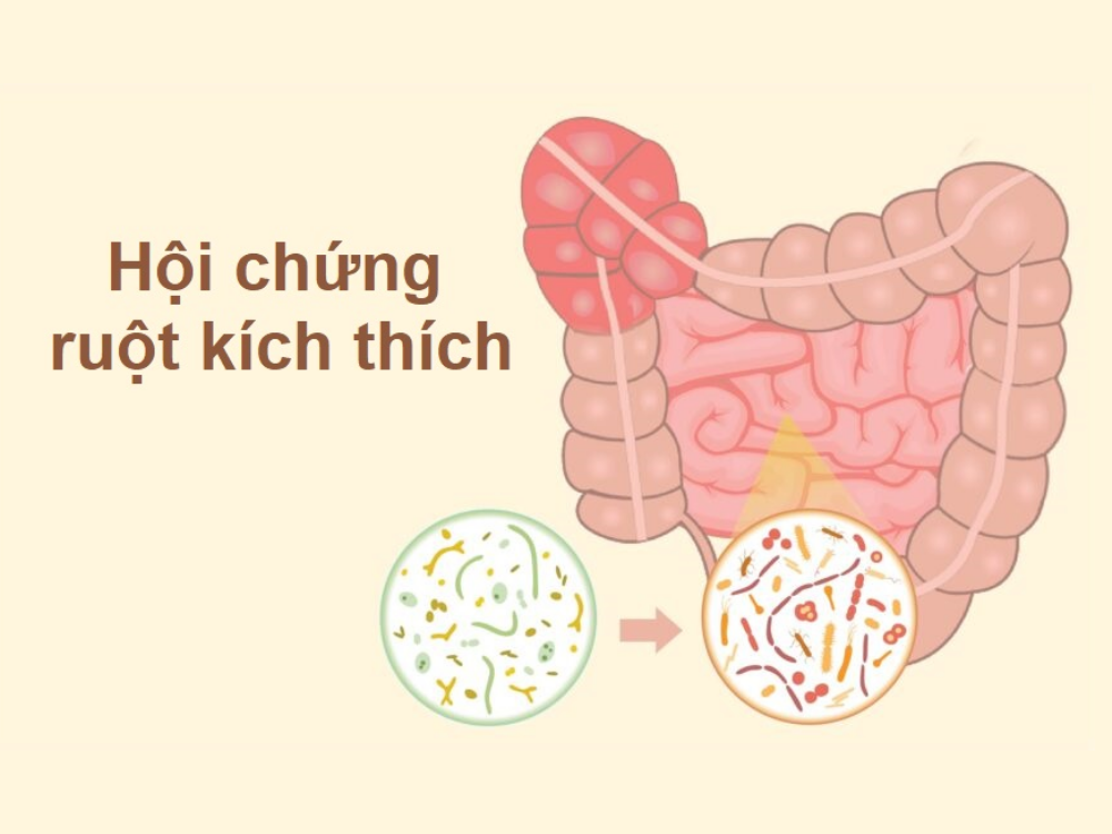 Hội chứng ruột kích thích và vi khuẩn đường ruột: Cách ổn định tỳ vị