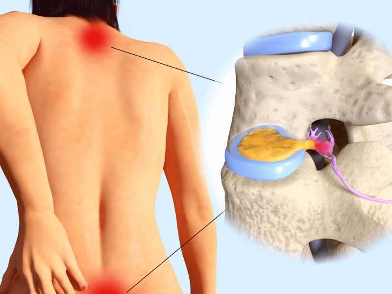 Vôi hóa cột sống: Hiểu rõ căn nguyên, chữa bệnh từ gốc