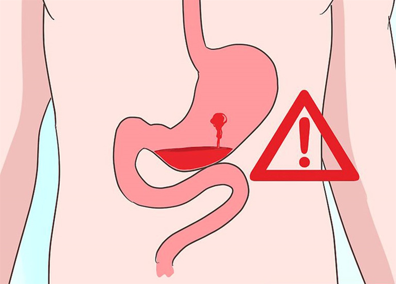 Xuất huyết dạ dày có phải mổ không? Lời dặn dò từ tâm can của Lão Tuấn