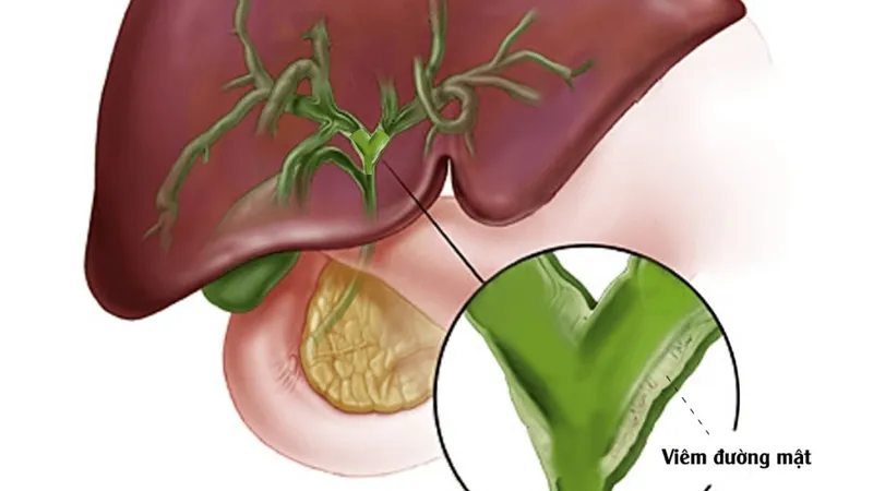 Biến chứng viêm đường mật: Đừng để "sát thủ" tàn phá gan mật