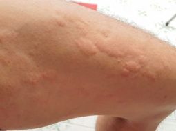 Nổi mẩn ngứa thành mảng: Đừng chủ quan coi thường kẻo "độc tích thành bệnh"