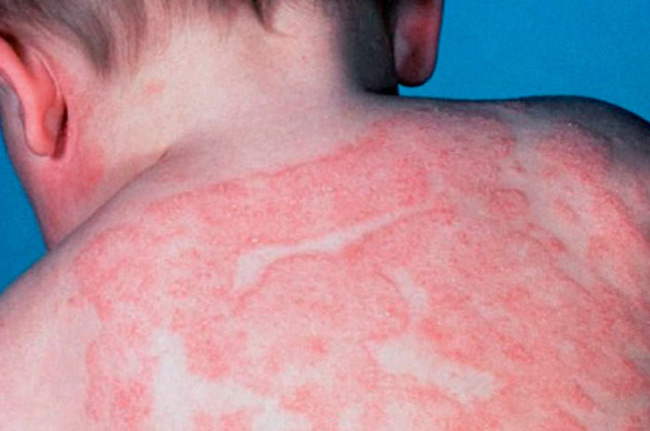 Trẻ bị mẩn ngứa từng mảng – Đừng xem thường dấu hiệu tưởng nhỏ