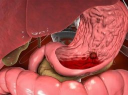 Dấu hiệu xuất huyết dạ dày: Đừng chủ quan kẻo họa sát thân