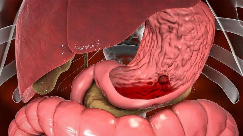Dấu hiệu xuất huyết dạ dày: Đừng chủ quan kẻo họa sát thân