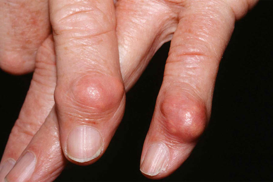 Gout mãn tính: Đừng để hạt tophi và biến chứng làm khổ thân già