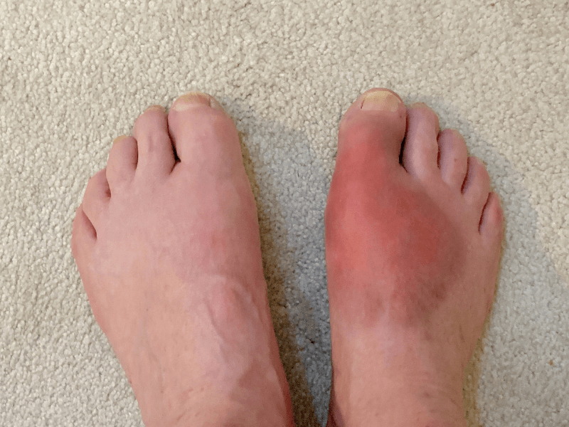 Bị Gout đau ở đâu nhiều nhất? Lời nhắn nhủ từ Lão Tuấn giúp bà con vơi bớt nỗi lo