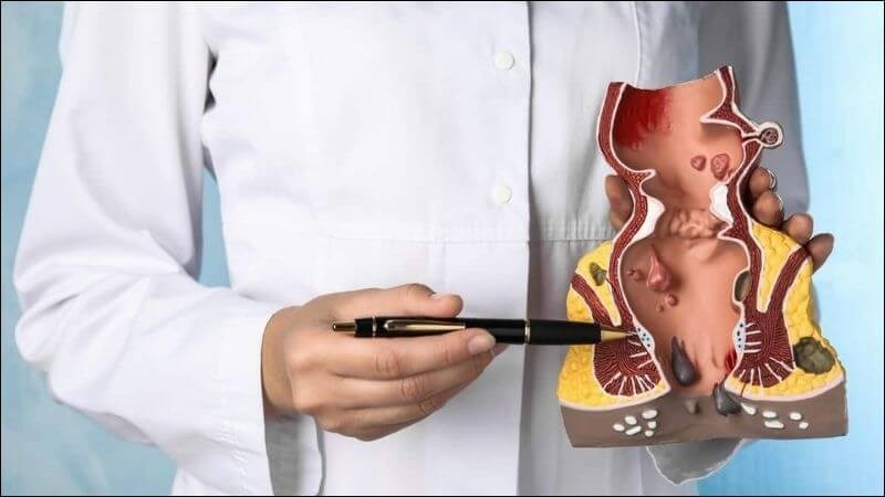 Điều trị bệnh trĩ: Bí quyết dứt điểm từ gốc của Lão Tuấn