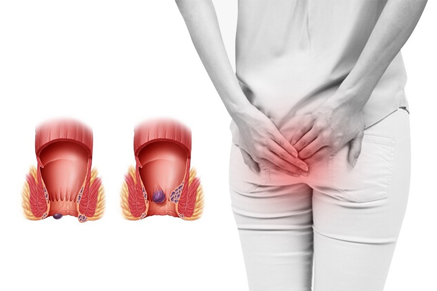 Triệu chứng bệnh trĩ: Nhận biết sớm để điều trị từ gốc hiệu quả